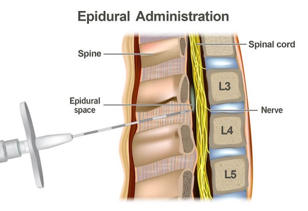 Epidural Injection Pain Medicine Specialists Of Arkansas