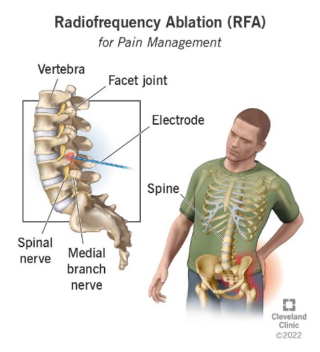 Radiofrequency Ablation Pain Medicine Specialists Of Arkansas